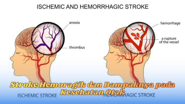 Stroke Hemoragik dan Dampaknya pada Kesehatan Otak